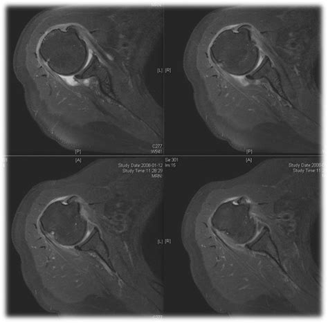 The Influence Of Bicipital Groove Morphology On The Stability Of The