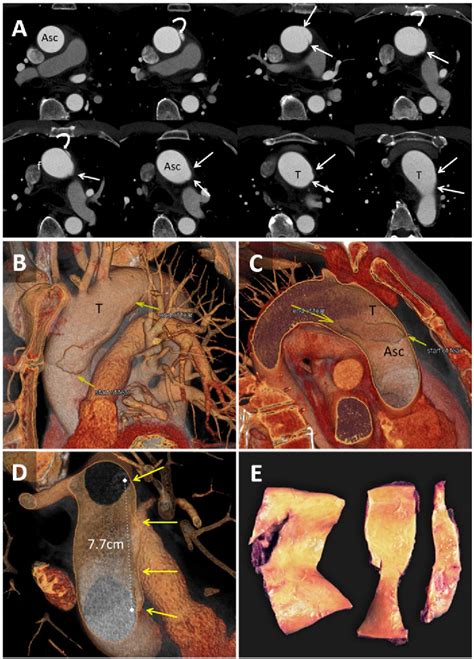 Figure 1 From Acute Limited Intimal Tears Of The Thoracic Aorta