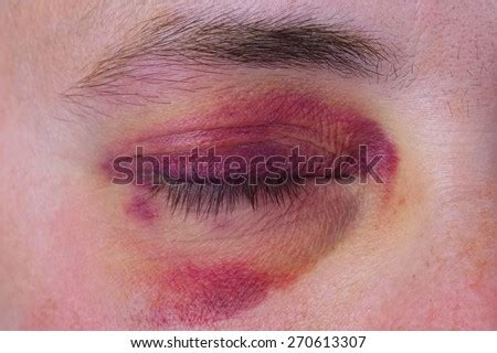 Bruised Eye Stock Photos, Images, & Pictures | Shutterstock