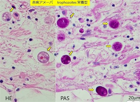 CPC報告 赤痢アメーバ（2） | 水戸済生会総合病院 臨床研修ブログ