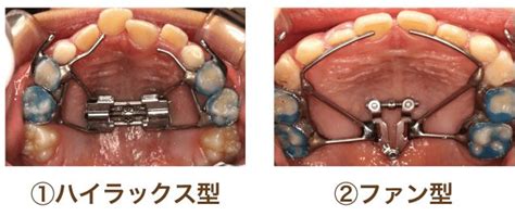 子どもの歯、矯正はじめます。調べた3つの矯正方法と費用のこと ぱちキスの家ブログ