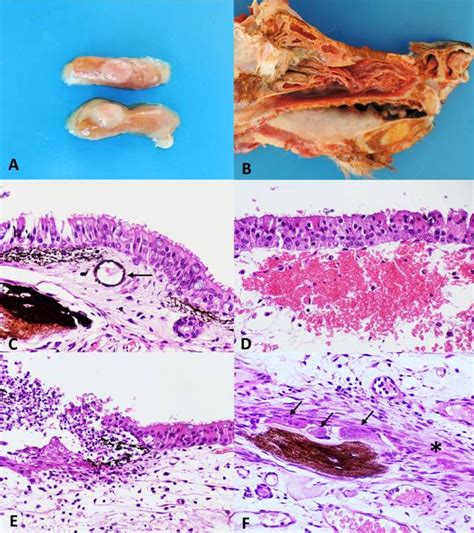 Scielo Brasil Nasal Mucosal Mineralization Ulceration And