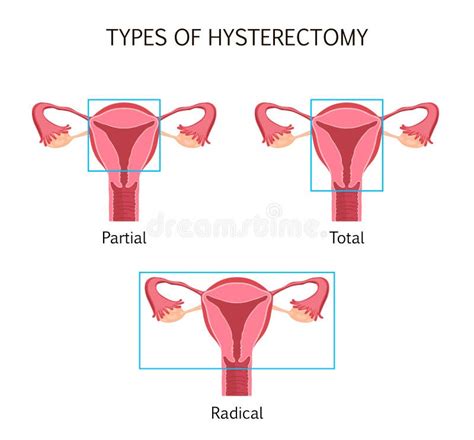 Hysterectomy Surgical Removal Of The Uterus Medical Vector