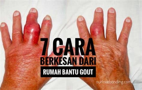 7 Cara Berkesan Hilangkan Dan Redakan Sakit Gout Secara Alami Dan