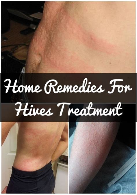 How To Get Rid Of Hives Fast Home Remedies