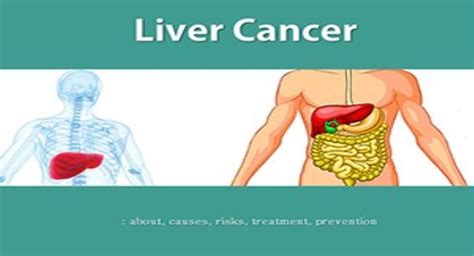 Free Download Liver Cancer Powerpoint Ppt Presentation Slidesfinder