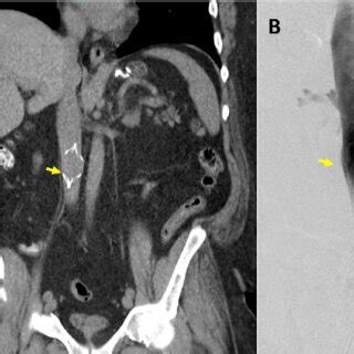 Pre-retrieval evaluation. A CT scan showed IVC filter (yellow arrow ...