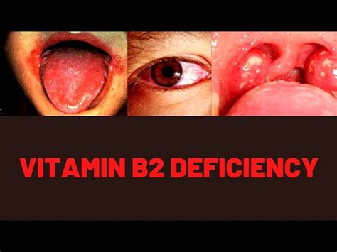 Vitamin B2 Deficiency