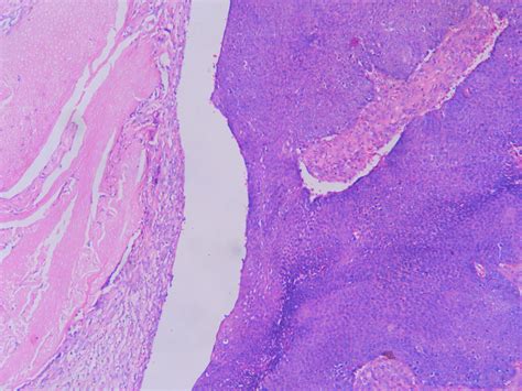 PILOMATRICOMA – Histopathology.guru