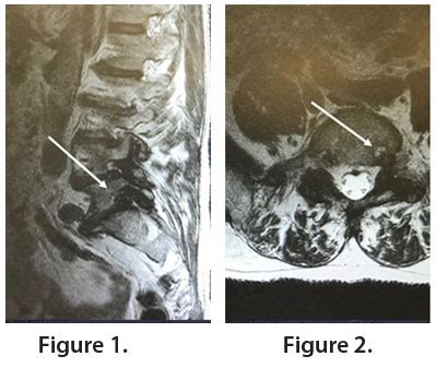 Extraforaminal L5-S1 Left Lumbar Side Herniation Causing Severe L5 ...