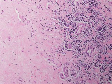 Pathology Outlines Lichen Sclerosus Balanitis Xerotica Obliterans