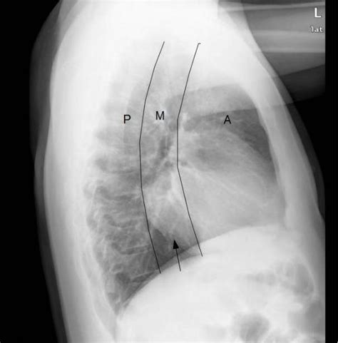 Incidental Finding Of Unclear Mediastinal Mass Eurorad