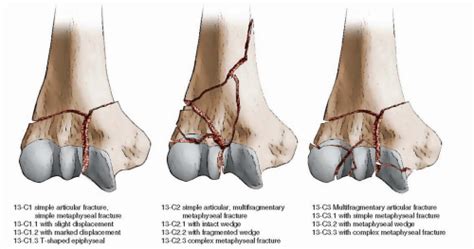 Intra Articular Fractures Of The Distal Humerus Total Elbow