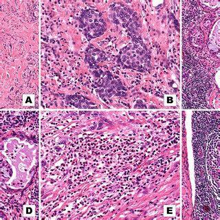 Histopathologic Findings Of Case Mec A Low Power Field Shows Nests