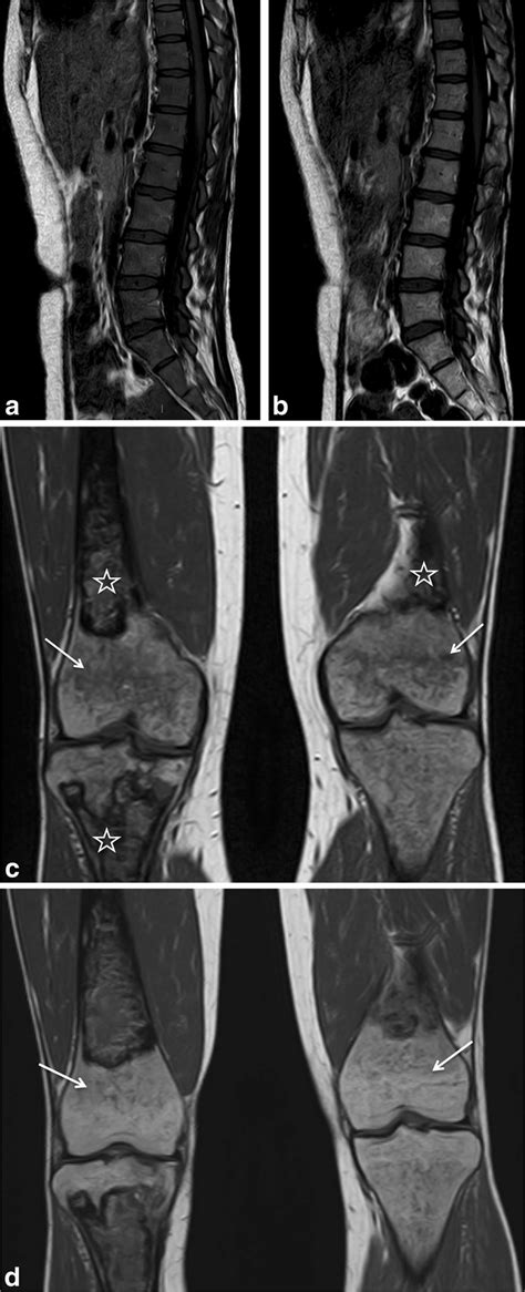 Spine And Femur Mri Of A Patient With Type Gaucher Disease Before