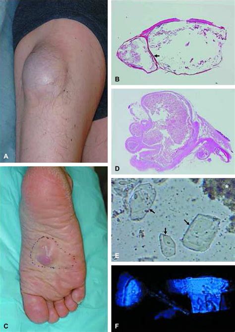 Multilocular Giant Epidermal Cysts Journal Of The American Academy Of