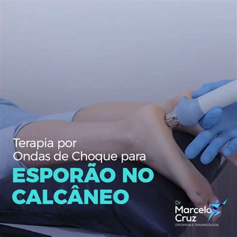 Terapia por Ondas de Choque para Esporão no Calcâneo Dr Marcelo Cruz