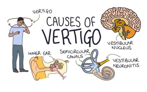 Restoring Balance Treating Vestibular Neuronitis With Rehabilitation