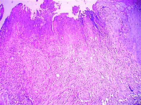 The Histopathological Photomicrograph Showing Discontinuous Epithelium