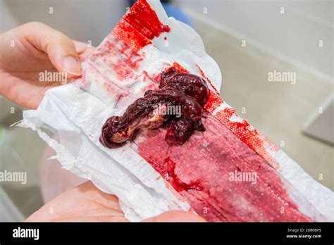 The Miscarriage Blood On The Napkin Showing The Miscarriage Sign On