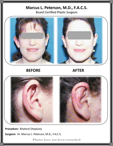 Ear Surgery - Center For Advanced Plastic Surgery