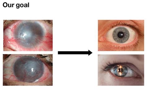 Bioengineered Stem Cell Transplants For Corneal Regeneration