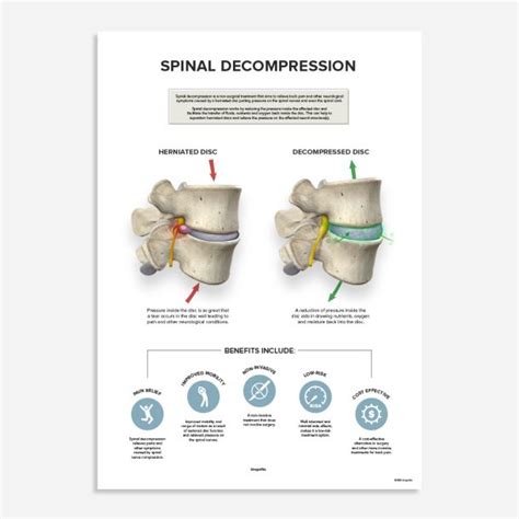 Spinal Decompression poster - Kirografiks