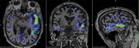 Eeg Correlated Fmri Map Of The Patient References Department Of R D