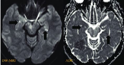 Dw Mri Shows Areas With Restricted Diffusion In Both Hippocampi