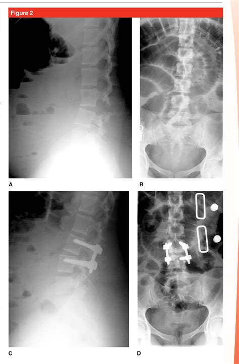 Figure 2 from Paralytic Ileus in the Orthopaedic Patient | Semantic Scholar