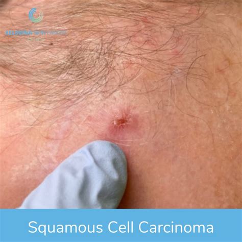 Early Squamous Cell Carcinoma Scalp