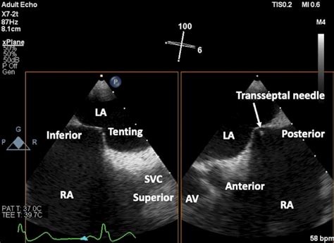 Transseptal Puncture Guidance Using Two Dimensional Transesophageal