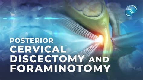 What Is Endoscopic Posterior Cervical Discectomy And Foraminotomy