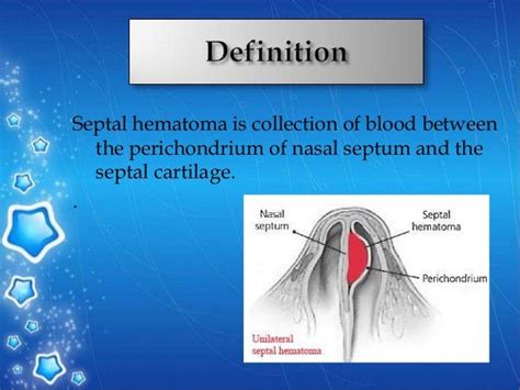 Septal hemotoma