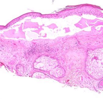 Epidermis Shows Hyperkeratosis Parakeratosis And Dysplasia Of