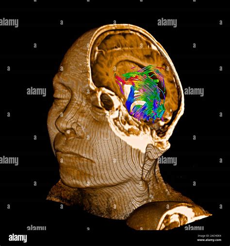 Tumeur Au Cerveau D Couleur L Imagerie Du Tenseur De Diffusion Dti