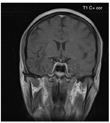 Imagen de resonancia magnética cerebral contrastada corte coronal en