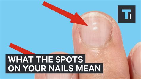 What White Marks On Nails Mean About Health Youtube