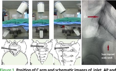 Figure 1 From Percutaneous Ilio Sacral Screw Fixation In Supine