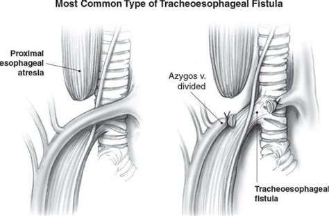 Esophageal Atresia Repair