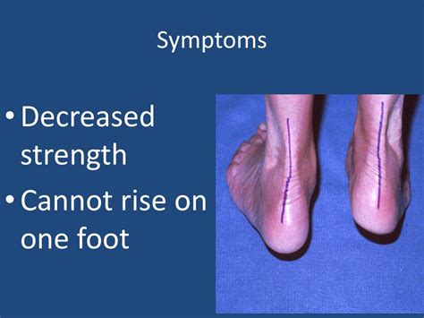 Ppt My Ankleposterior Tibial Tendon Insufficiency Powerpoint