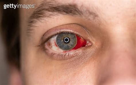 Bloodshot Human Eye With Noticeable Subconjunctival Hemorrhage Blood