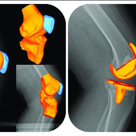 Six DOF changes in tibiofemoral kinematics across the range of knee ...