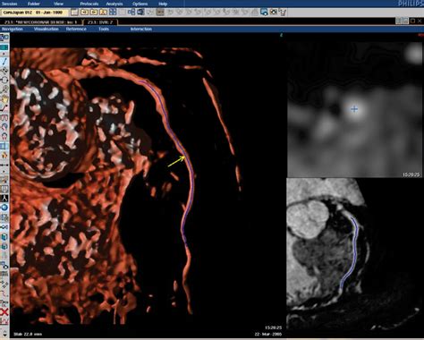 Fast And Robust Visual Inspection Of The Coronary Arteries Based On