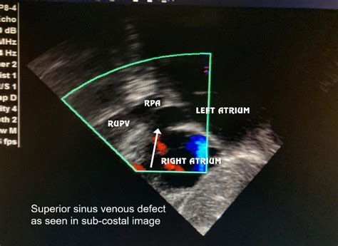 MID -- TERM POST-OPERATIVE OUTCOME OF SINUS VENOSUS ATRIAL SEPTAL ...