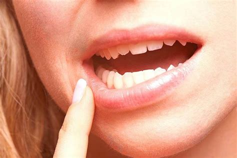 Oral Stomatitis Causes Types Of Stomatitis Prevention And Treatment