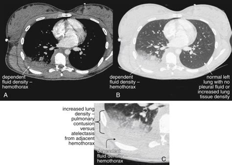 Imaging Chest Trauma Radiology Key