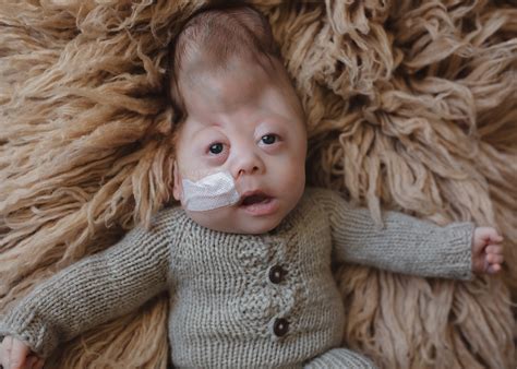Dandy Walker Malformation Children