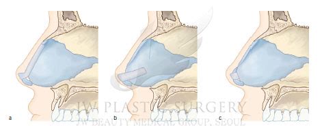 Jw Plastic Surgery Center Korea The Basic Of Nasal Tip Plasty Types