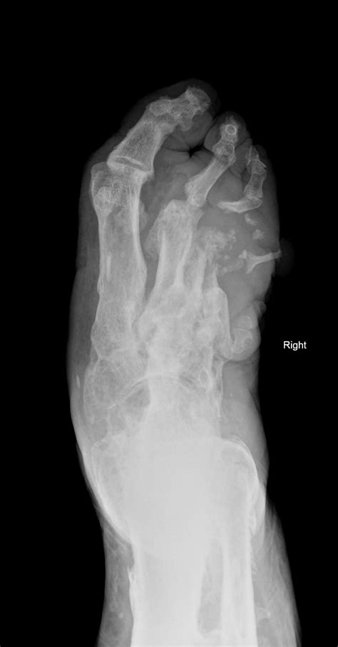 Chronic Osteomyelitis Image Radiopaedia Org